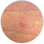 Basal Cell Carcinoma