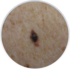 melanoma