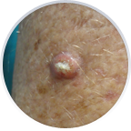 Squamous Cell Carcinoma